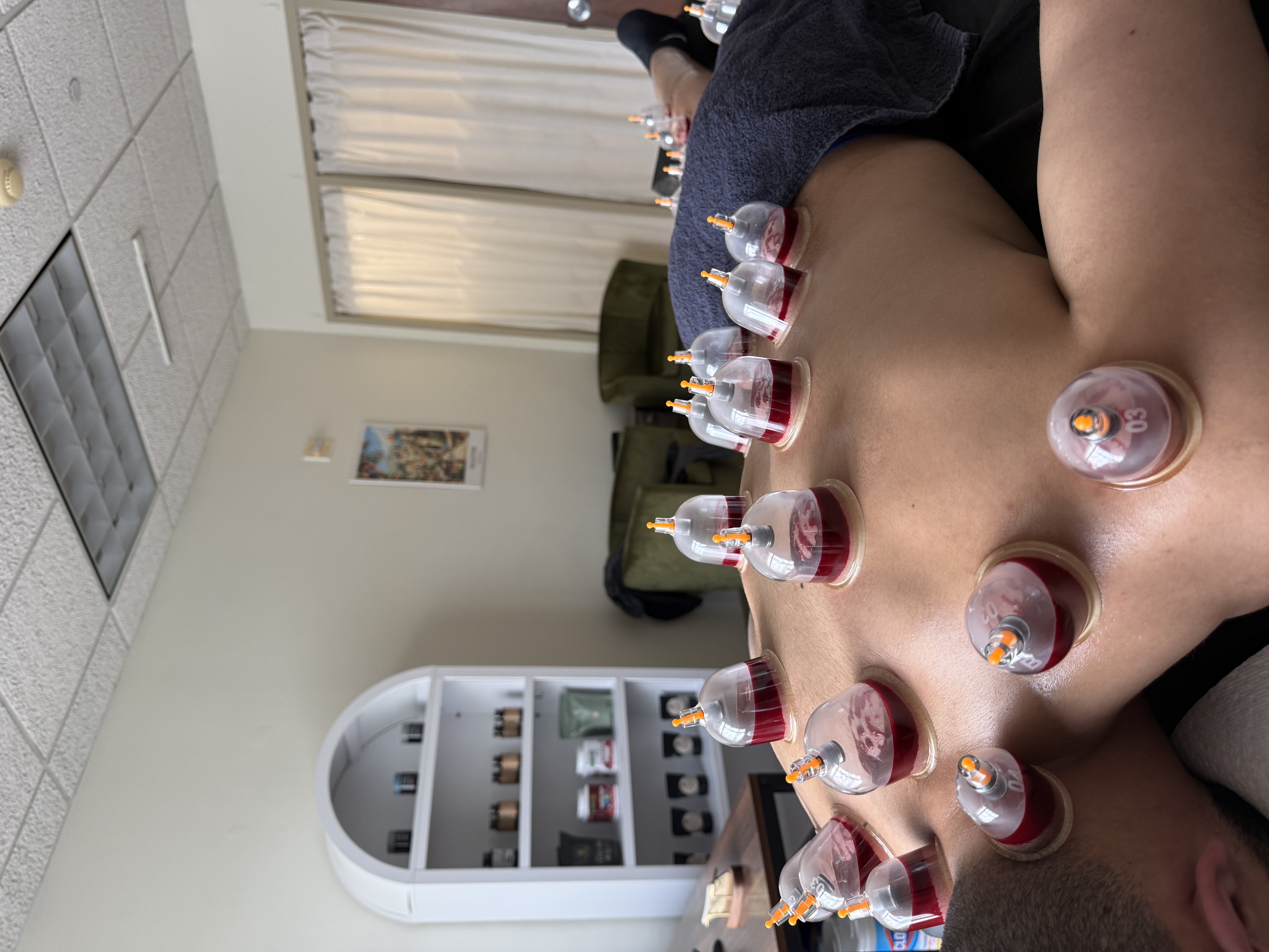 Dry Cupping & Hijama — the new way